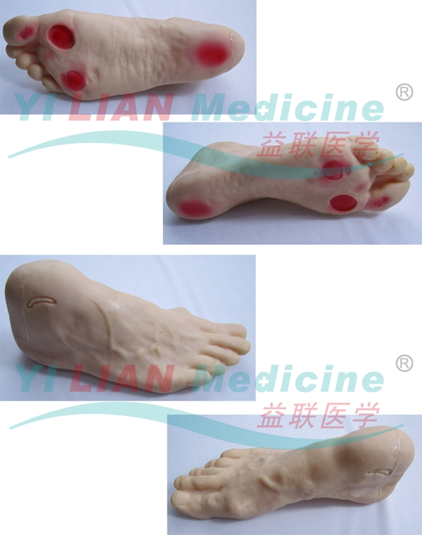 高級糖尿病足護理模型