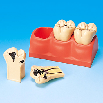 齲齒分解剖模型